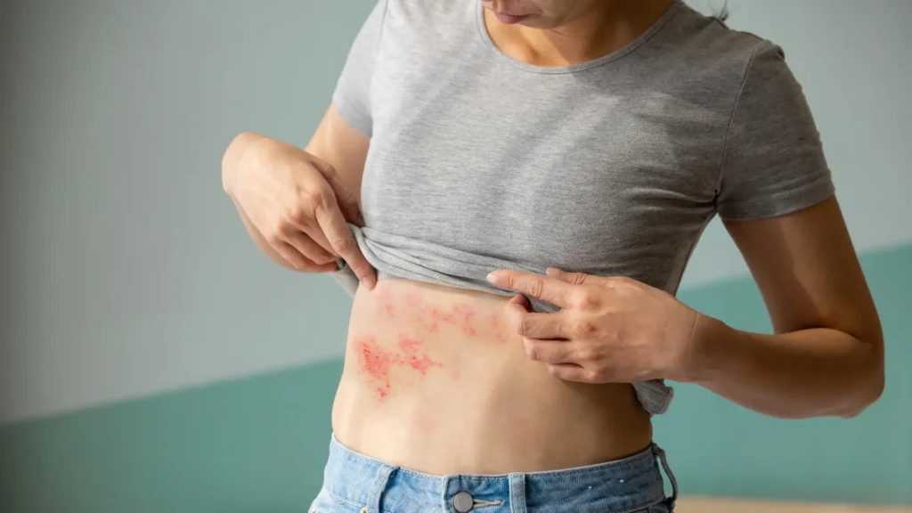 A woman with postpartum hives on her stomach.